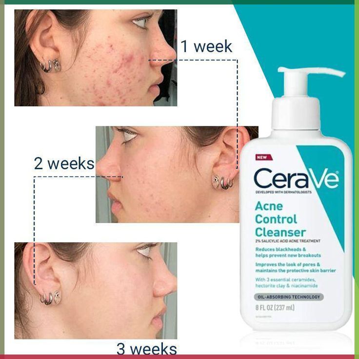 CeraVe Acne Control Cleanser – Clear Skin & Oil Control Face Wash